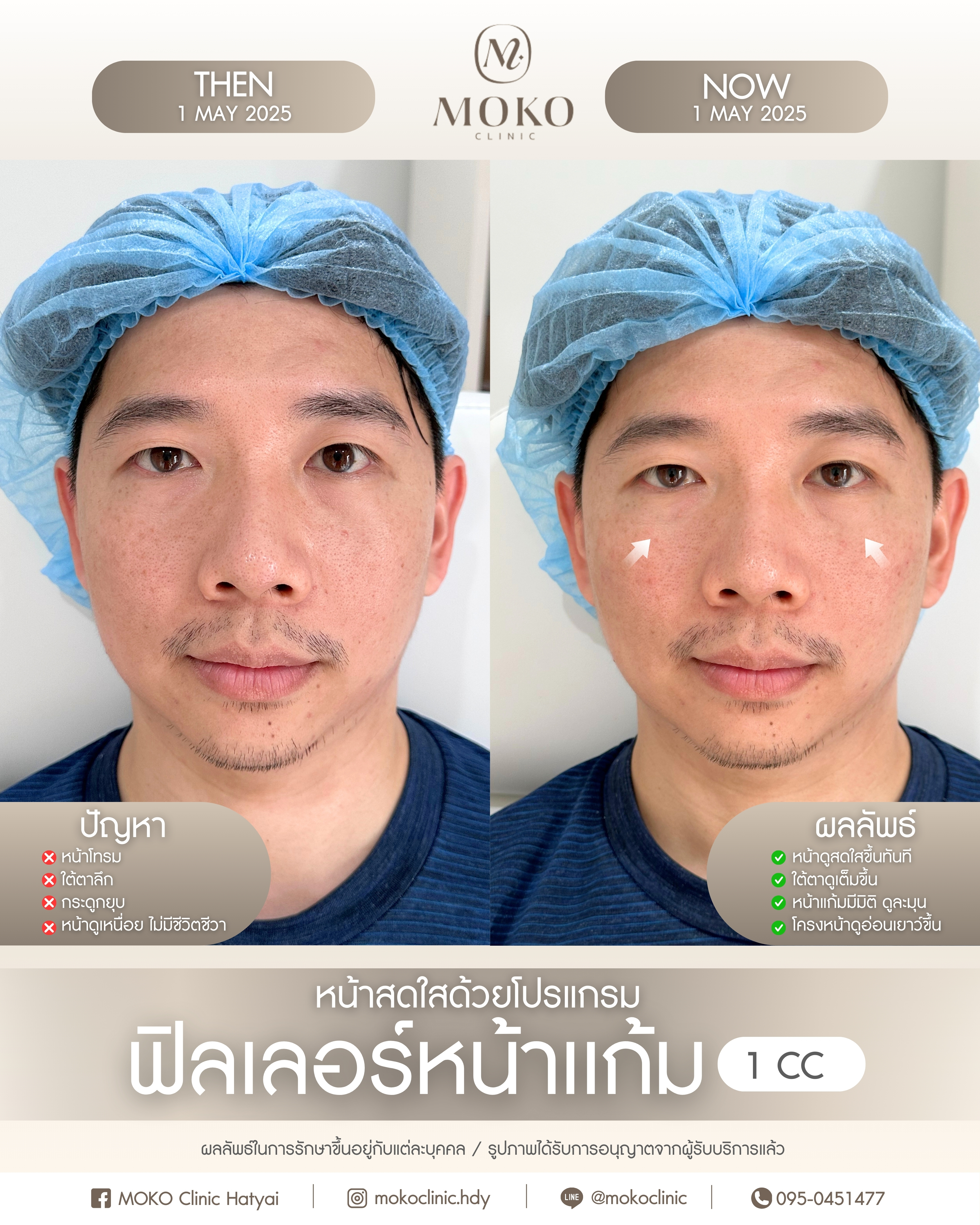 Before After Results 5